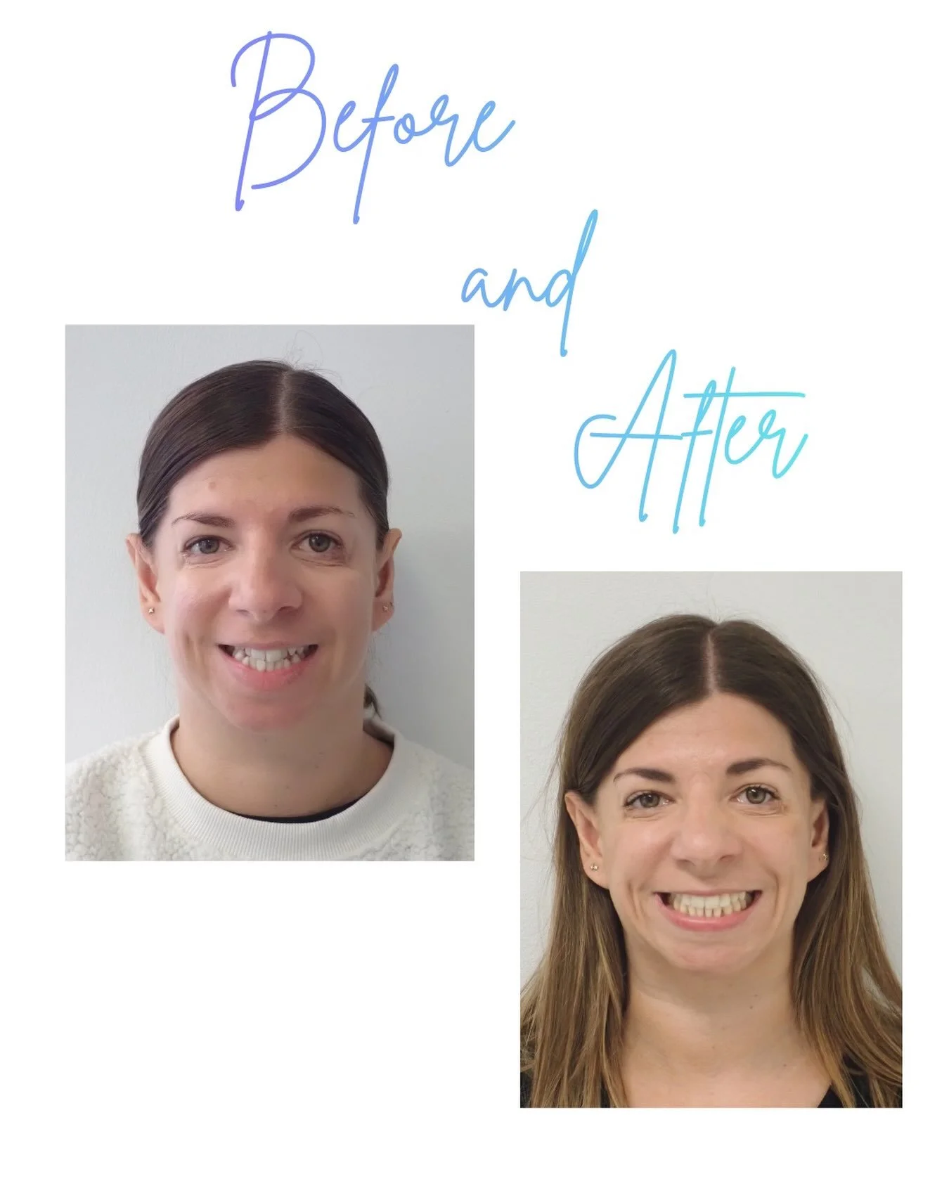 💎 New smile alert! 💎 

Karen recently finished her bespoke treatment with our member @harpsandstalbansortho , and her results speak for themselves.
👏 
Why wait for the smile you&rsquo;ve always wanted? @harpsandstalbansortho specialist team is rea