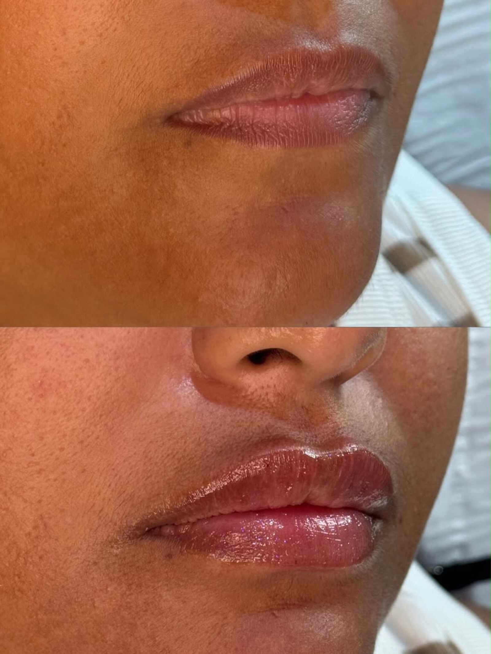 With our member @clinic103harpenden every lip filler treatment is tailored to your natural features, with a focus on subtle enhancement, proportion and refined results.
👄 
It&rsquo;s all about simply about enhancing what&rsquo;s already there, addin