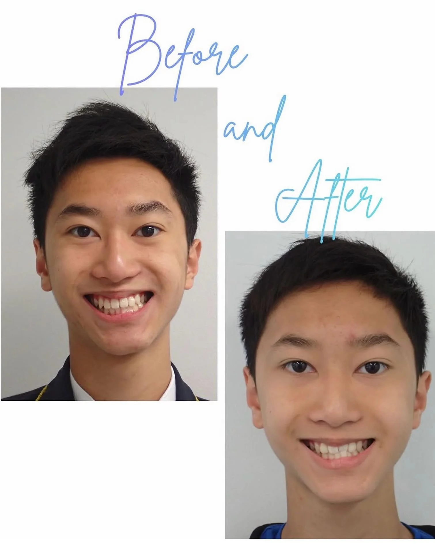 A great result like this doesn&rsquo;t happen overnight, it&rsquo;s all about the right plan, the right support, and consistency throughout treatment.
🦷
If you&rsquo;ve been thinking about improving your smile, our member @harpsandstalbansortho is h