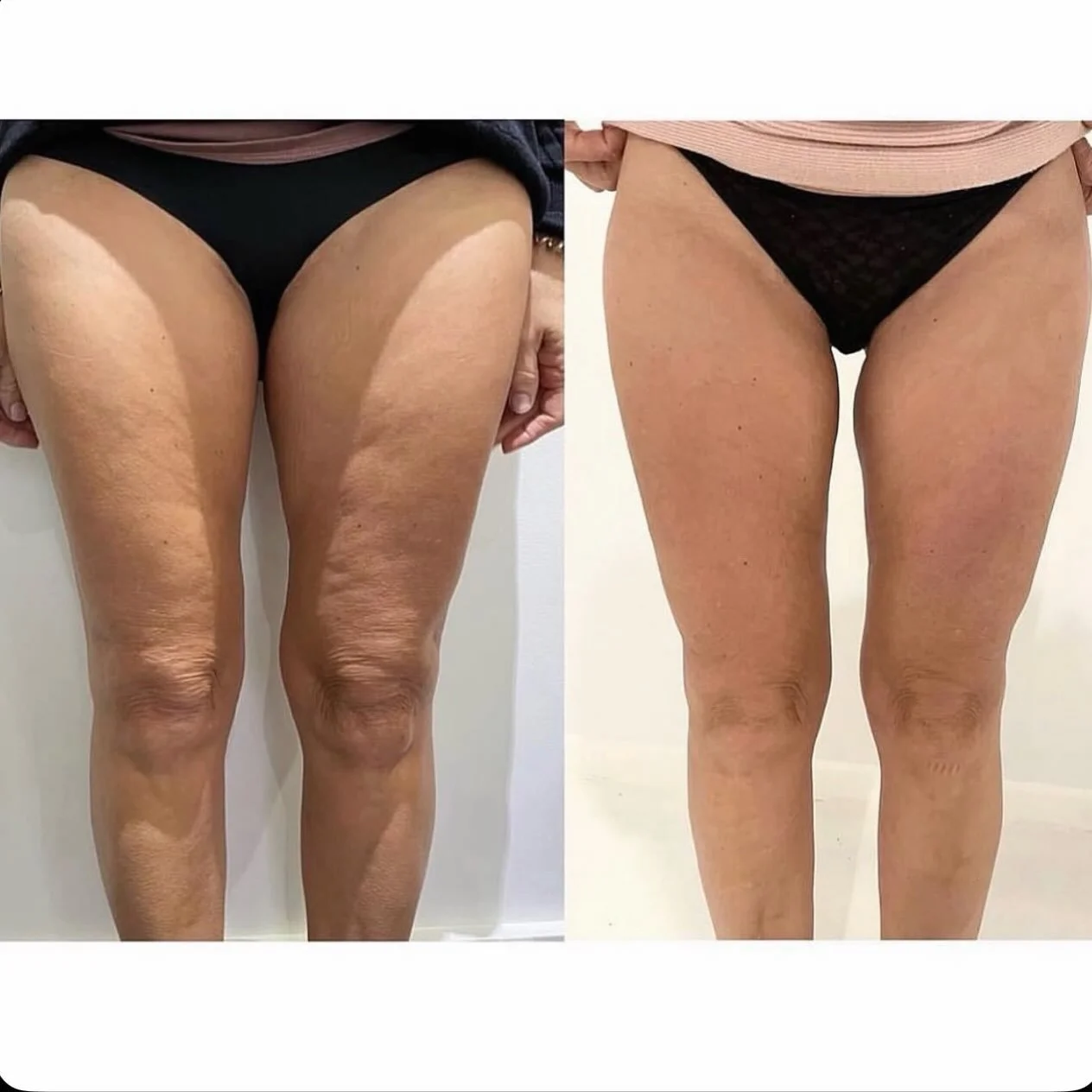 👻 Boo-tiful Legs! 👻

Before &amp; after results from our member @theal5aesthetics and their Legs course, and it&rsquo;s now on offer!
 🎃
Give your legs a little love with this spooktacular combination:
-  6 Emtone treatments
- 6 Emerald treatments
