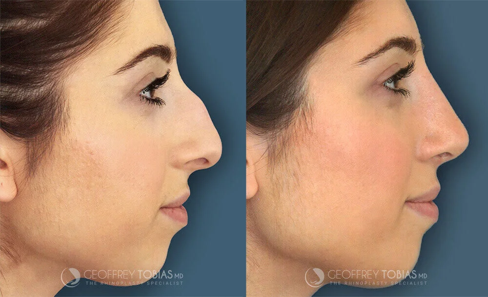 Female Rhinoplasty Before and After Side View