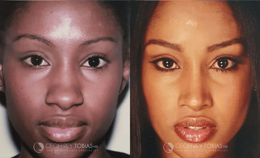 Female Rhinoplasty Before and After Front View