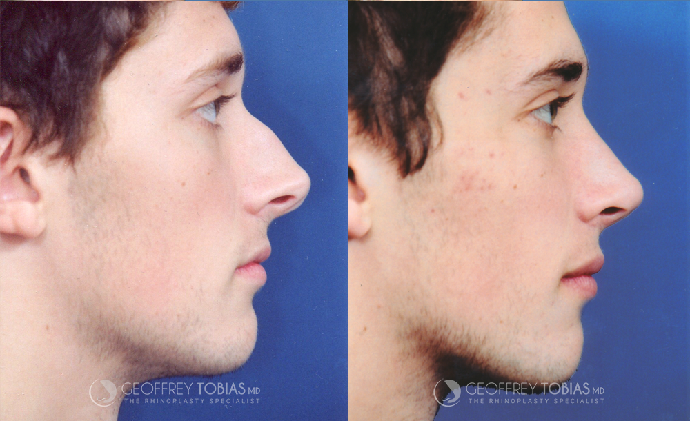 Male Rhinoplasty Before and After Side View