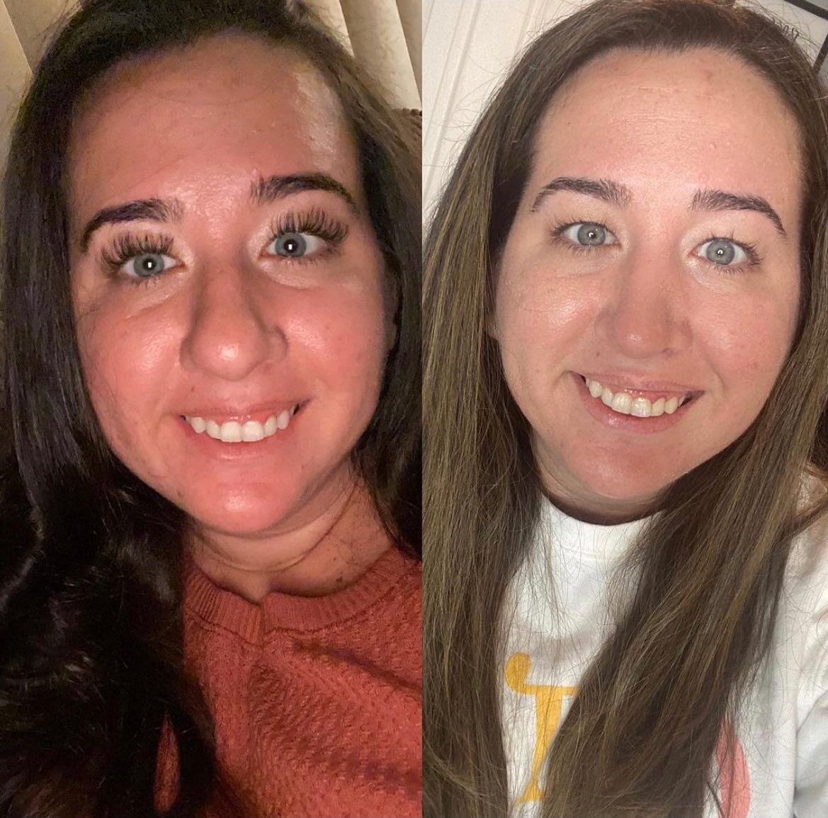 &ldquo;4 week post op! Surprise! New me, new nose! Do what makes you happy in this life because life is too short! To think my nose is still going to improve over the next 6-12 months blows my mind. I am so happy already with the results from @drtobi