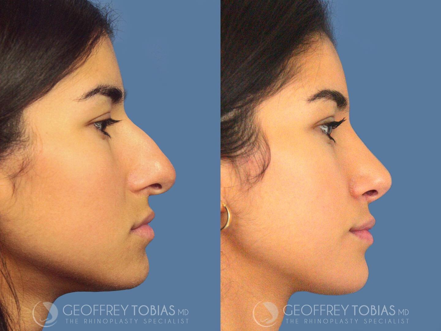 Saved under: profile goals ⚡️
#contouredbyTobias 👃🏼
.
.
.
Time: 2.5 hours
Treatment: Closed Rhinoplasty = 🚫 NO SCARS
Downtime: Rapid recovery! 4-7 days until you can return to work/school 
Results: Immediate! Final results achieved in 6-12 months
