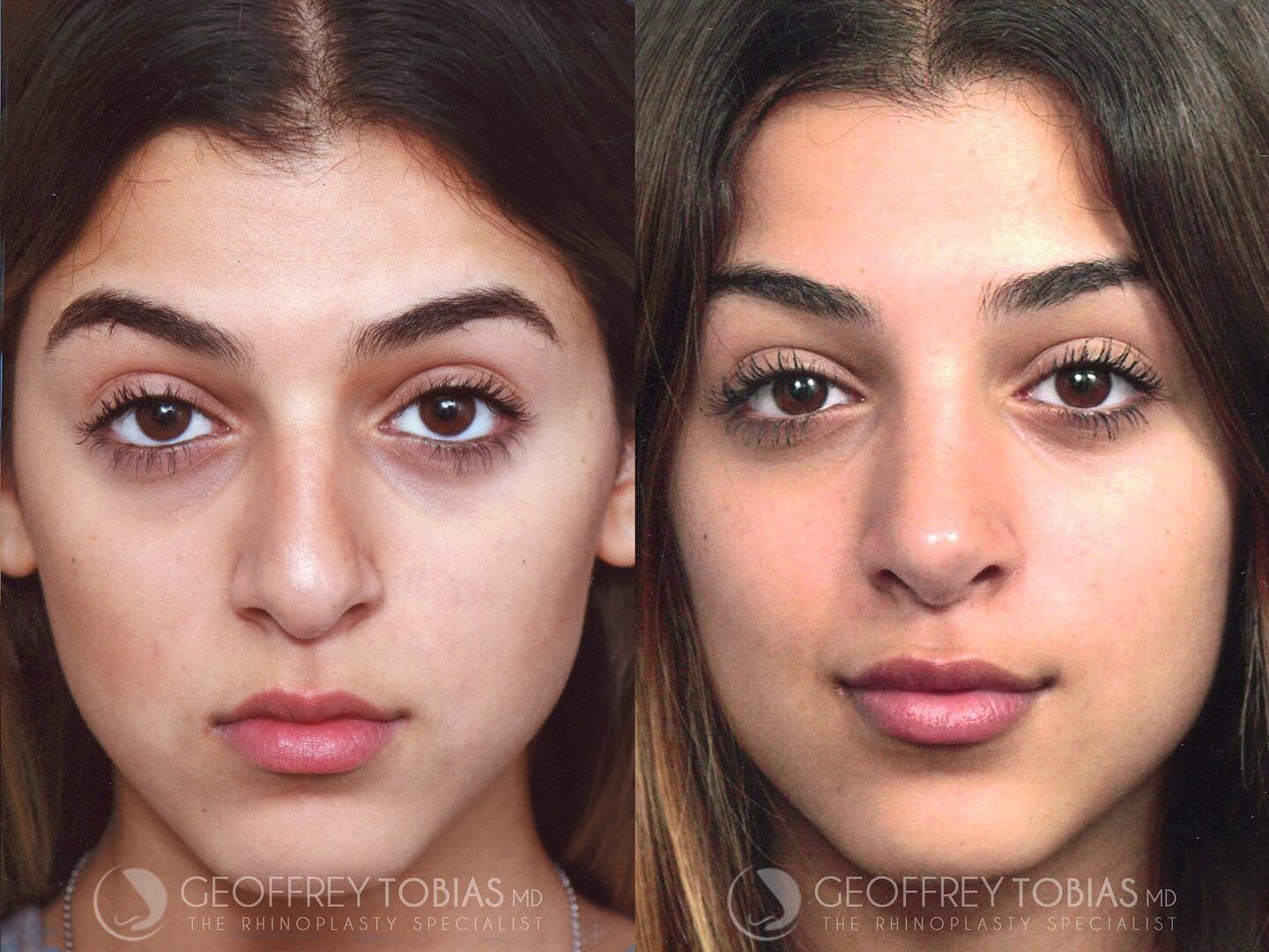 Dr. Tobias&rsquo; goal is always a natural, un-operated look ⚡️⚡️
#contouredbyTobias 
.
.
.
Time: 2.5 hours
Treatment: Closed Rhinoplasty = 🚫 NO SCARS
Downtime: Rapid recovery! 4-7 days until you can return to work/school 
Results: Immediate! Final 