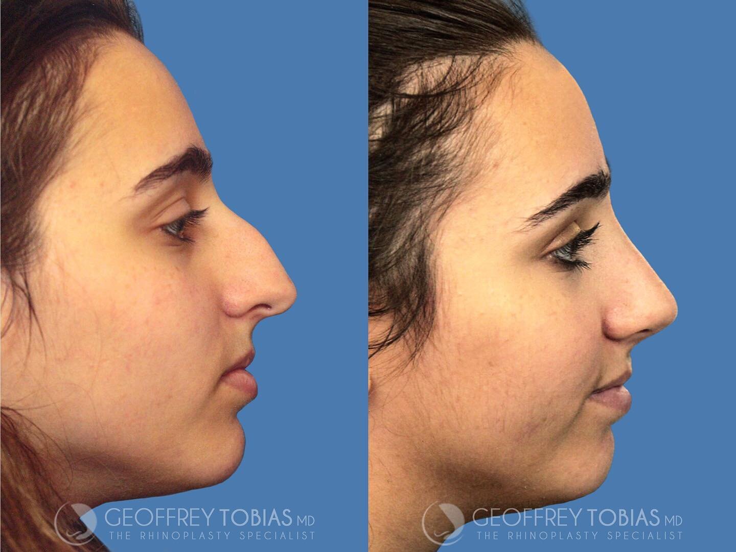 Nose Surgery - Rhinoplasty - West Coast Face