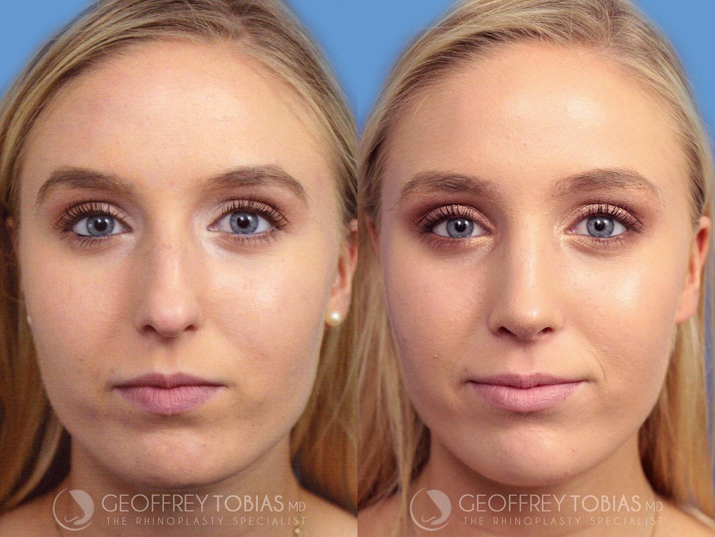 subtle change ➡️ striking result
#contouredbyTobias 👃🏽
.
.
.
Time: 2.5 hours
Treatment: Closed Rhinoplasty = 🚫 NO SCARS
Downtime: Rapid recovery! 4-7 days until you can return to work/school 
Results: Immediate! Final results achieved in 6-12 mont