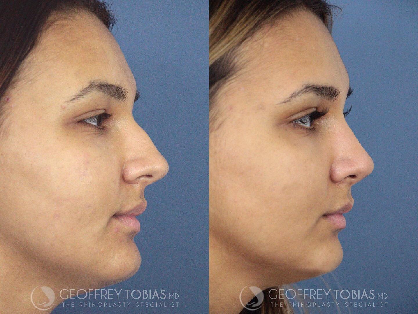 This patient had difficulty breathing and wanted a softer, feminine profile while keeping the results natural ⚡️Who wants to see the front view?
#contouredbyTobias 👃🏽
.
.
.
Time: 2.5 hours
Treatment: Closed Rhinoplasty = 🚫 NO SCARS
Downtime: Rapid