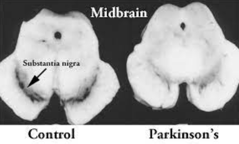 This image shows how there is a dark pigment to the substantia nigra in healthy controls, however, with the loss of dopamine in those with PD, you can see how the dark pigment is lost.