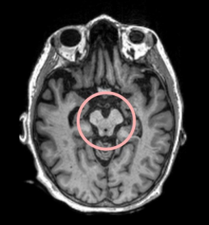 Understanding Progressive Supranuclear Palsy (PSP)