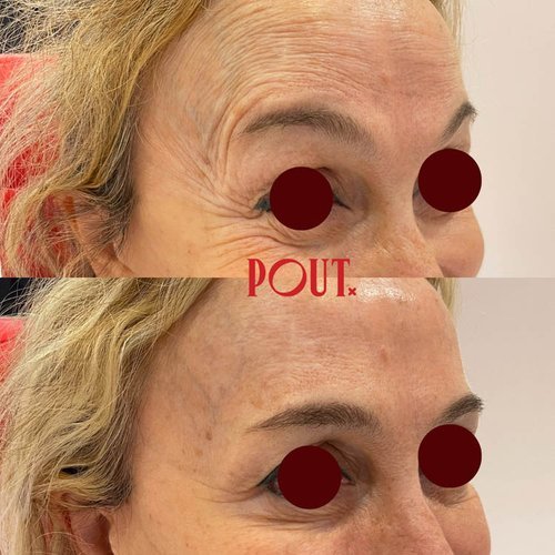 Poutx+Before+and+After+Botox+for+Natural+Looking+Eye+Wrinkle+Reduction