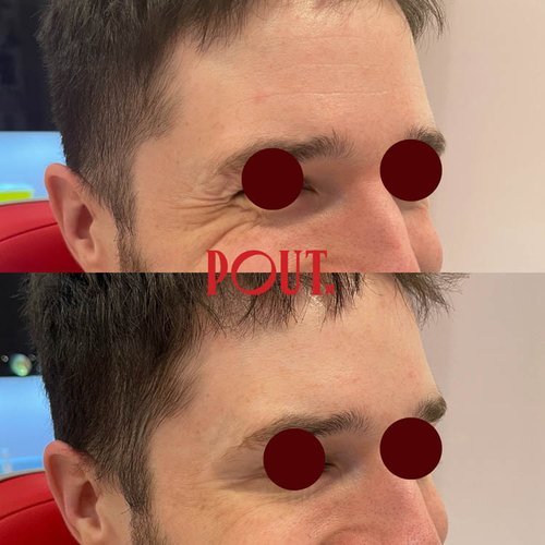 Botox+Before+and+After+Pics+for+Crow's+Feet+Poutx+Toronto