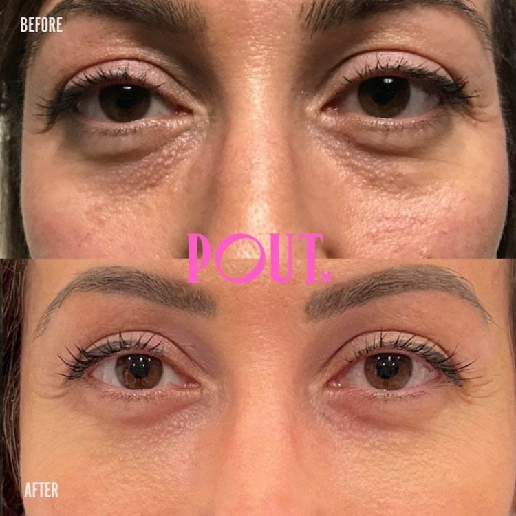 Cheek+Fillers+Before+and+After+Photos+Facial+Balancing+Women+Poutx+Clinic+Toronto