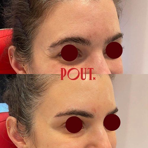 Before+and+After+of+Botox+Injections+for+Crow's+Feet+Eye+Wrinkle+