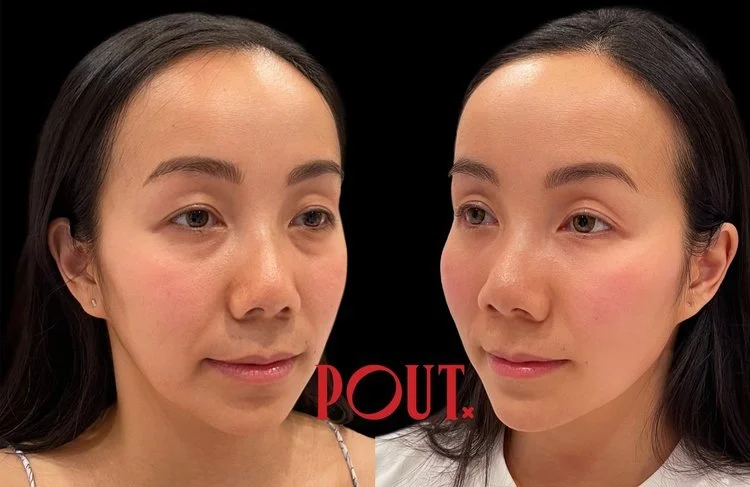 Why Balance Matters More Than Volume in Facial Aesthetics