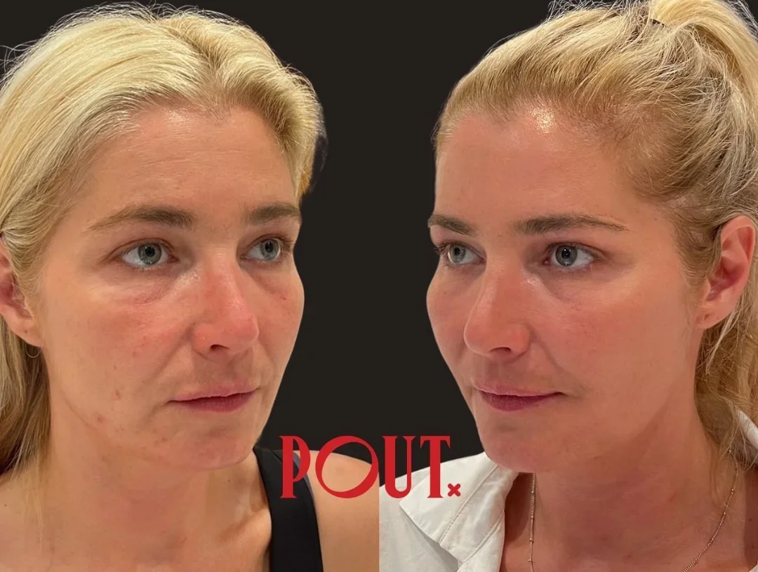 How to Achieve Natural Results with Facial Balancing Treatments