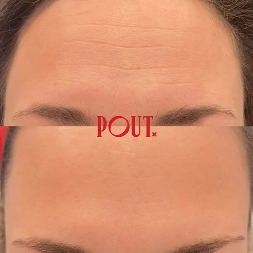 Wrinkles vs Fine Lines: What’s the Real Difference?
