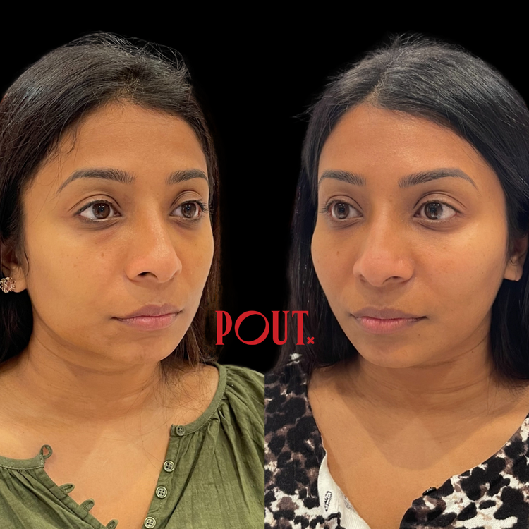 Combining Botox and Fillers for Jawline Slimming and Facial Balance