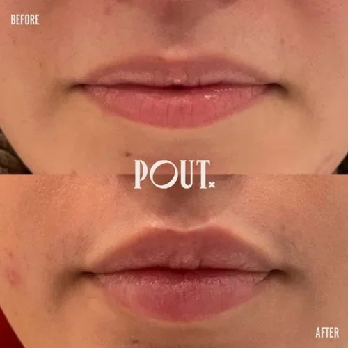 The Science Behind Lip Fillers: How They Actually Work