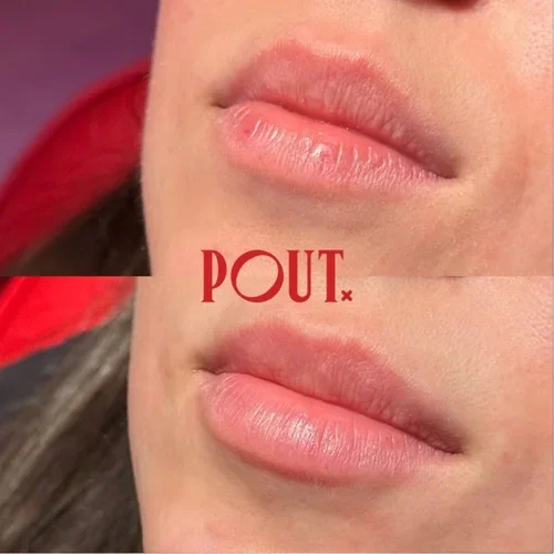 From Overfilled to Effortless: Correcting Filler Gone Wrong