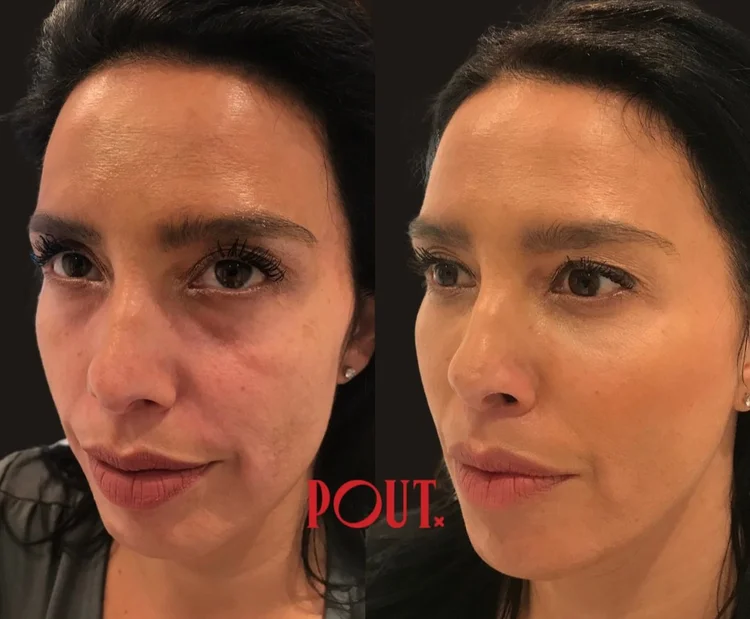 Can Botox Lift the Lower Face