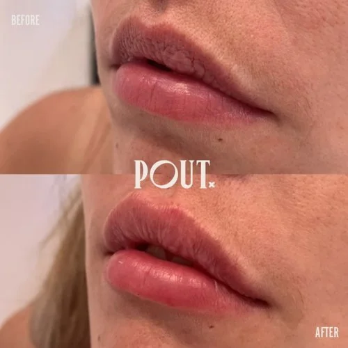 Lip Filler Trends 2026: What’s Old, What’s New, and What’s Next