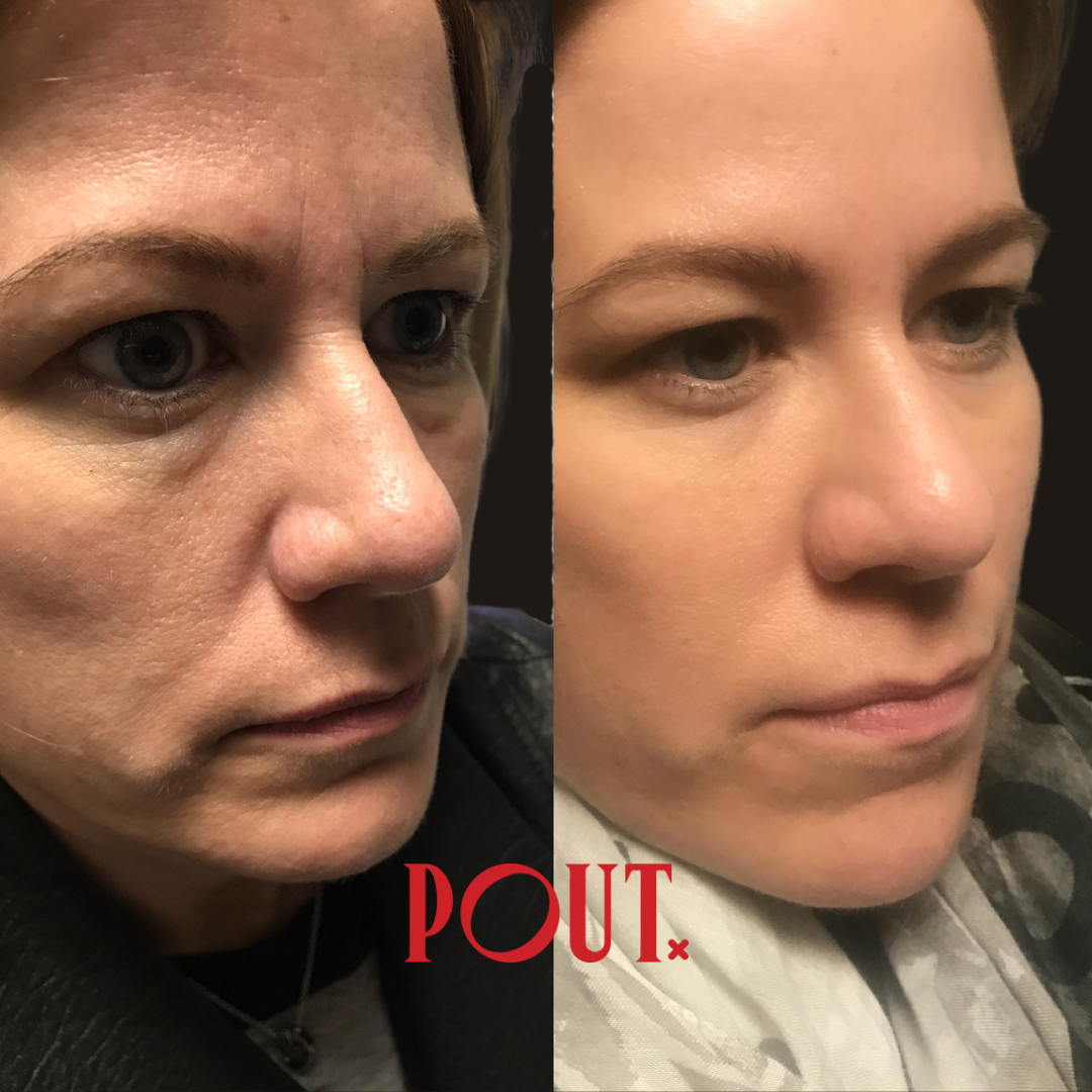 The Hidden Impact of Mouth Breathing on Facial Asymmetry