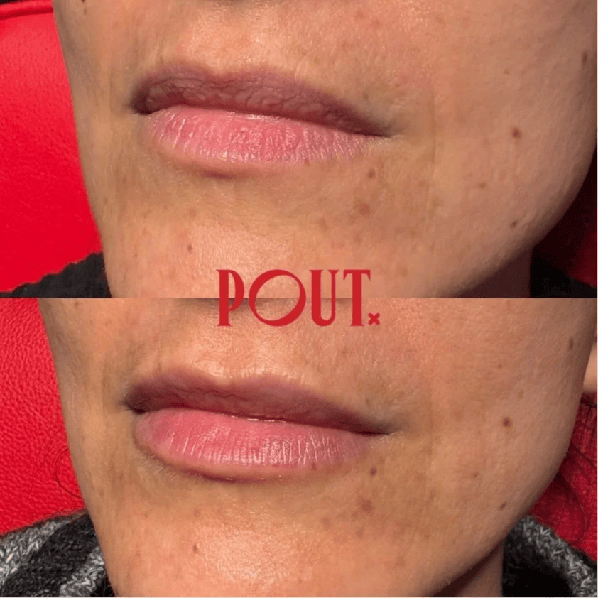 The Difference Between Hydration and Volume in Lip Fillers