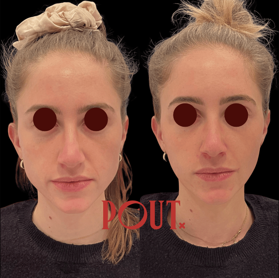 Jawline Slimming for Bruxism Sufferers: The Full Journey