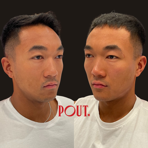 Spotting an Overfilled Face: Why Natural Looking Results Begin With Facial Balance