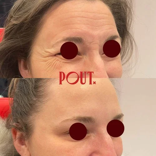 Preventative Aesthetics: The Best Treatments for Your 30s &amp; 40s