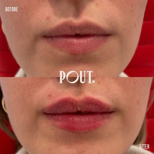 Best+lip+filler+clinic+in+Toronto