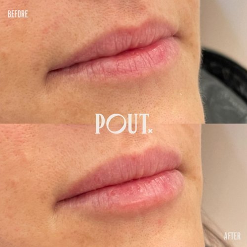 Best+lip+filler+and+injections+clinic+in+Toronto