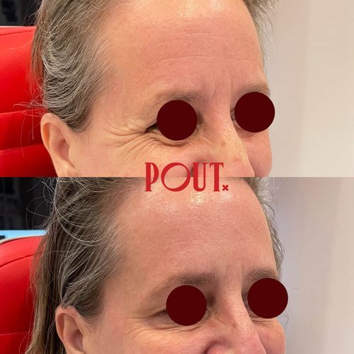 Botox+Injections+Before+and+After+Photos+++Poutx+Clinic+Toronto.jpg