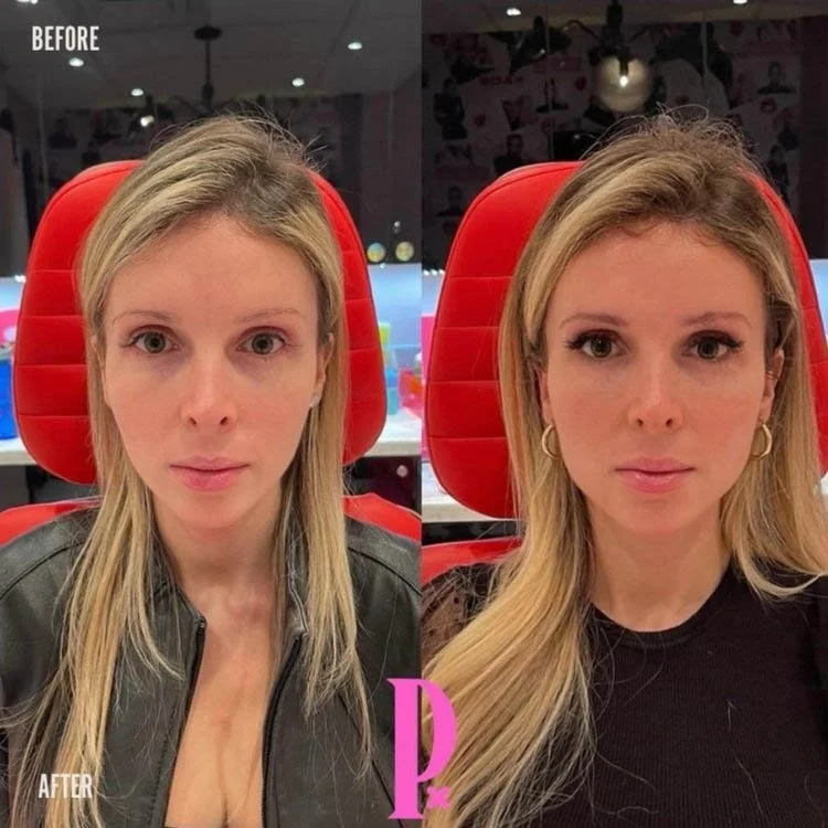 Women Cheek Fillers for a Balanced Before & After Full Face Balancing Poutx Toronto