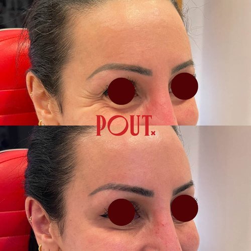 Poutx+Botox+Before+and+After+Results+for+Crow's+Feet+in+Toronto