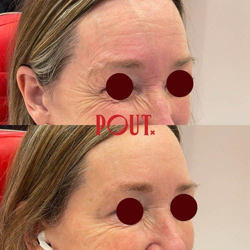 Botox+Results+Before+and+After+Eye+Wrinkle+Specialist+in+Toronto.jpg