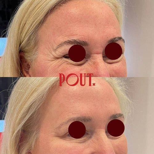 Natural+Botox+Results+for+Crow's+Feet+Poutx+Clinic+Toronto