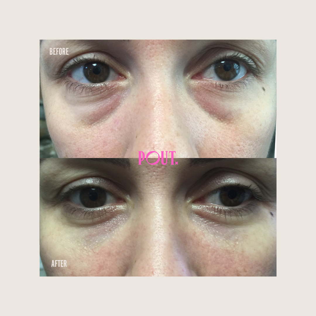 Filler — Botox & Filler by The POUT Clinic | REAL Results. ZERO confusion.