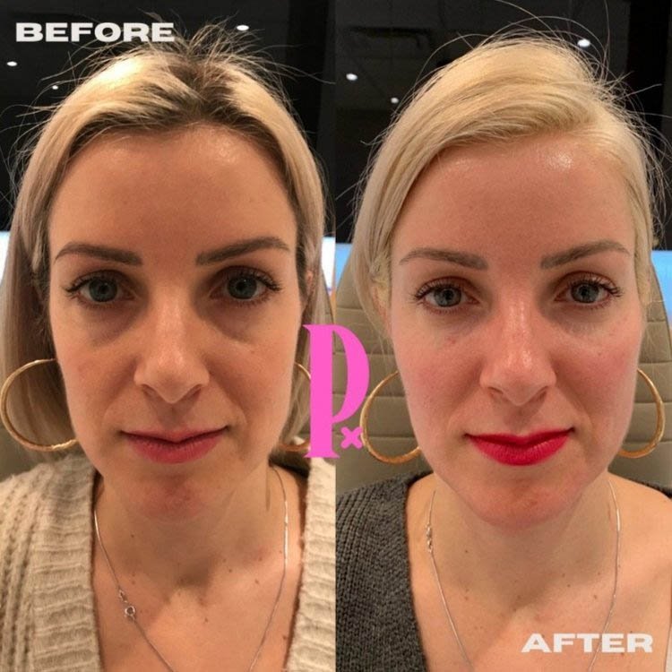 Women+Cheek+Fillers+for+a+Balanced+Before+and+After+Full+Face+Balancing+Poutx+Toronto