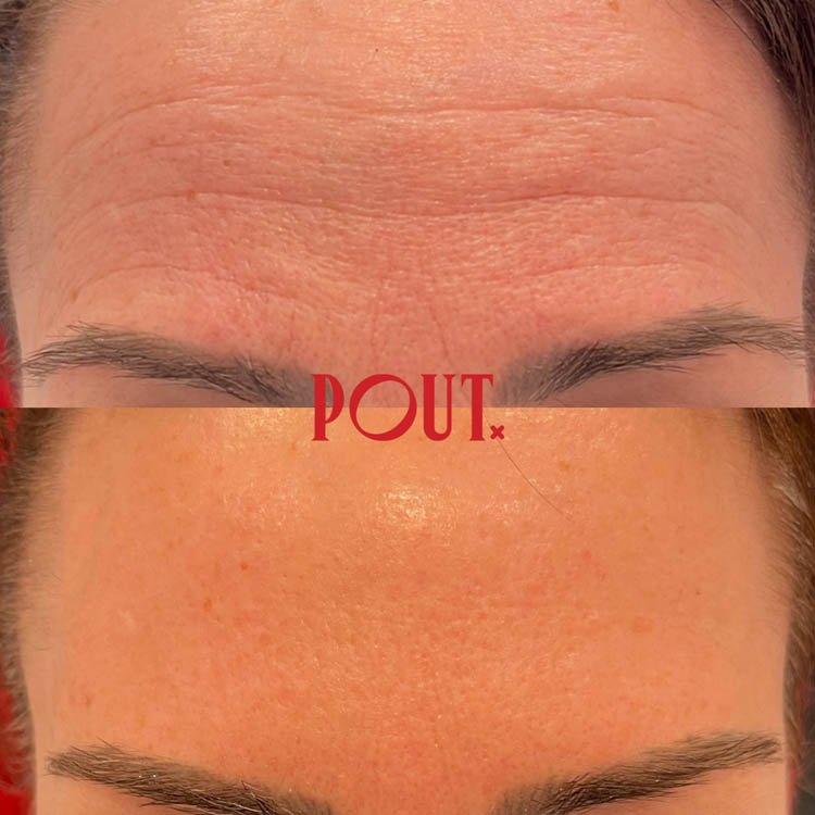 Before and after of Botox forehead line injections Poutx Ttoronto.jpg