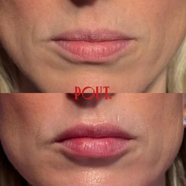 hydratednotinflated lip