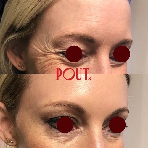 Botox+Injections+Before+and+After+Photos+Poutx+Clinic+Toronto