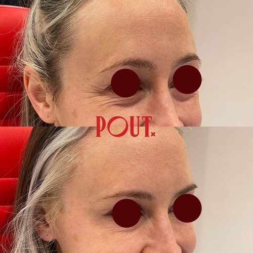 Natural+Eye+Wrinkle+Reduction+with+Botox+at+Poutx+Injections+Toronto