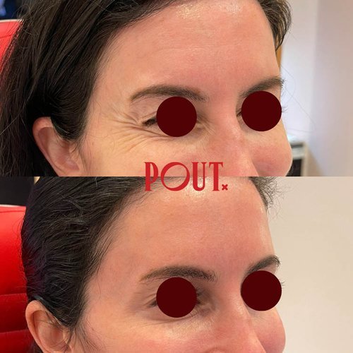 Botox+Results+Before+and+After+Eye+Wrinkle+Specialist+in+Toronto