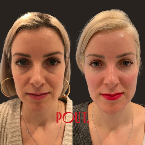 The Best Injectable Treatments for Under-Eye Volume Loss