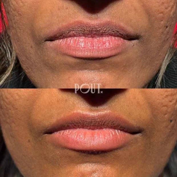 Lip fillers