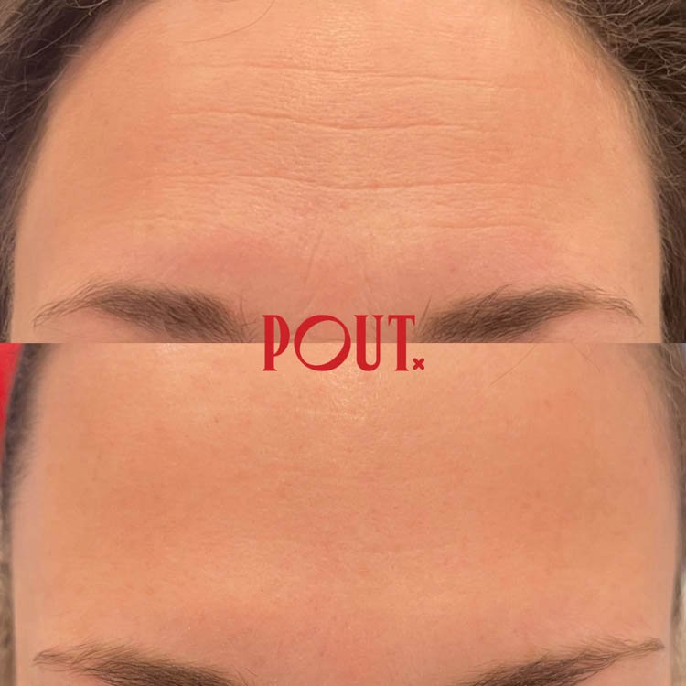 Botox best injections forehead lines before after results toronto wrinkle reduction in Toronto.jpg
