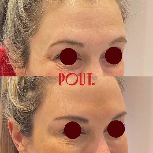 Botox+Injections+Before+and+After+Photos+++Poutx+Clinic+in+Toronto